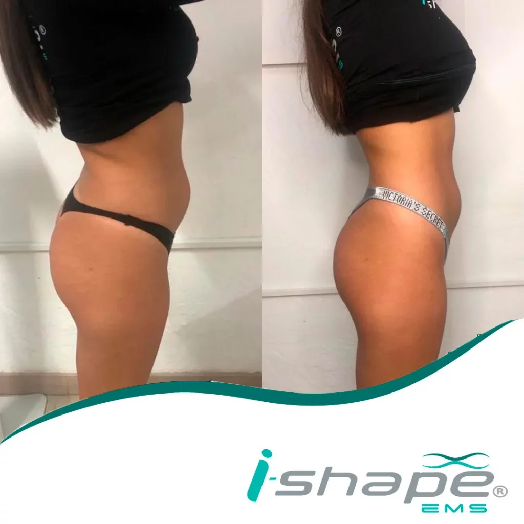 Avant après corps I Shape Esthetic