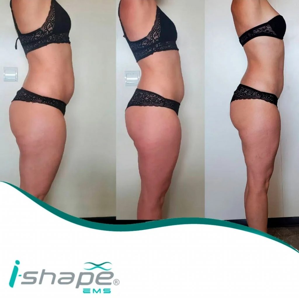 Avant après I Shape Esthetic